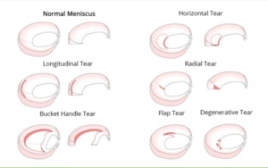 Meniscal tears: the basics - BSM Foundation