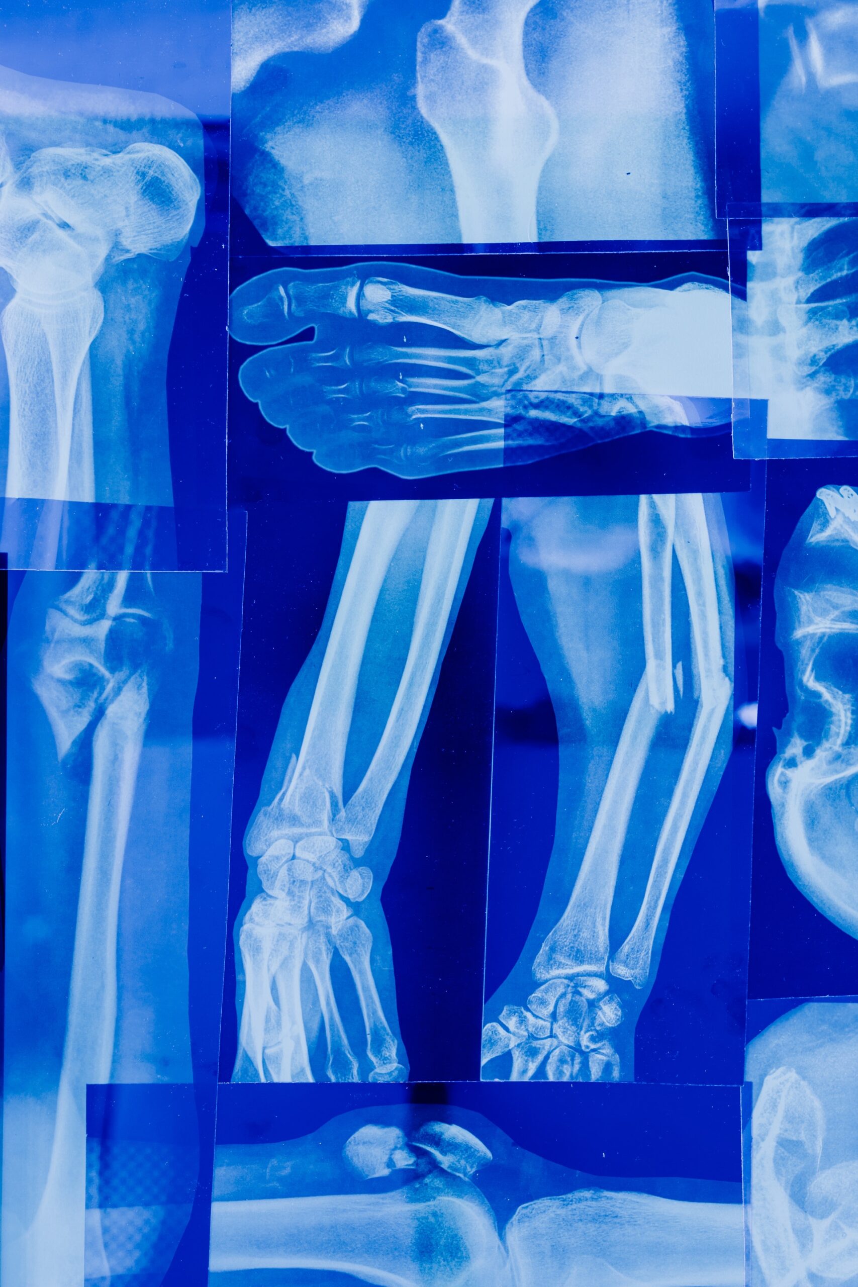 x-rays of broken bones