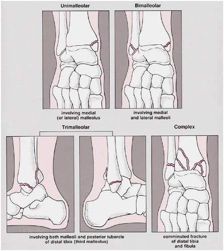 Ankle Fracture - Welk Security & Trust