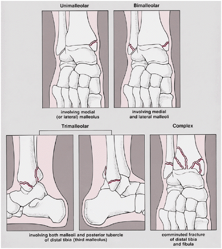 Ankle-fractures, Musculoskeletal, What-we-treat