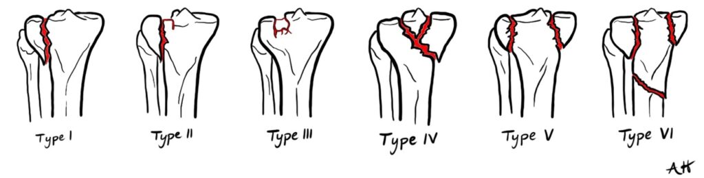 Schatzker classification of tibial plateau fractures